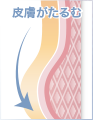 皮膚がたるむ